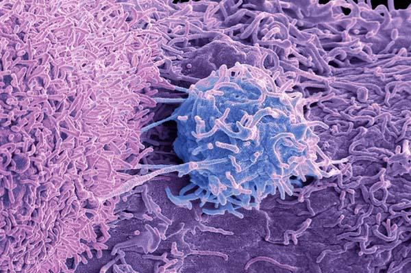 Image from a scanning electron microscope of prostate cancer cells. The cells show numerous fine surface projections.